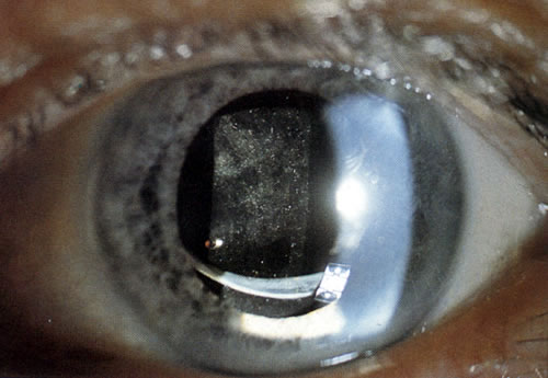 Yag Laser Capsulotomy Yag Laser Capsulotomy