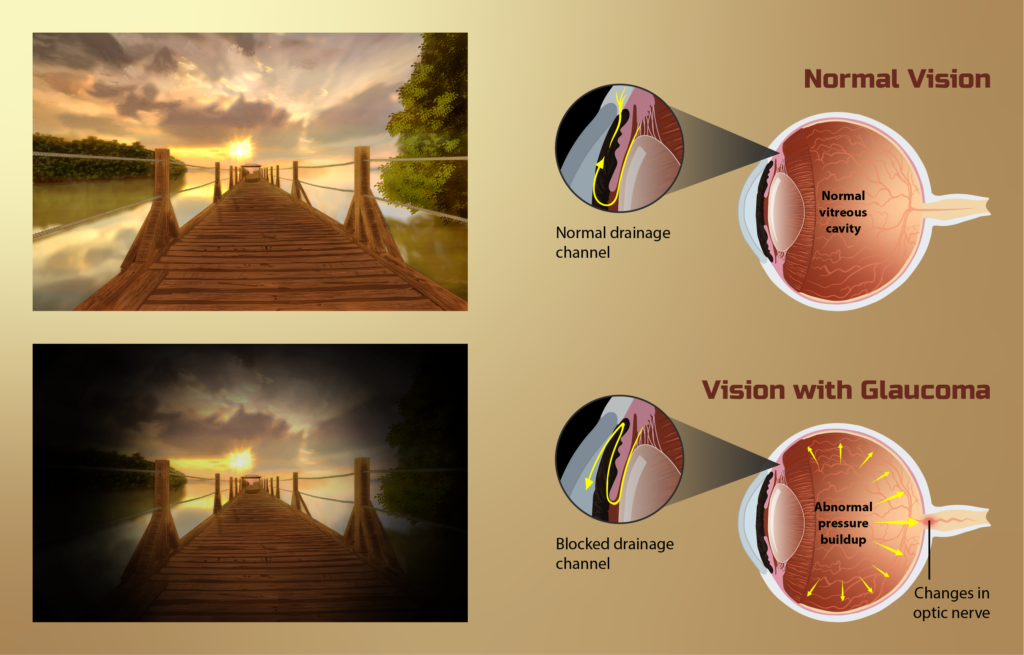 Graphic Normal Vision and Vision with Glaucoma Graphic Normal Vision and Vision with Glaucoma