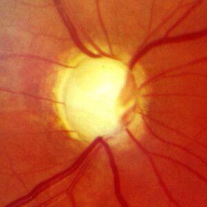Optic nerve with glaucomatous cupping Optic nerve with glaucomatous cupping
